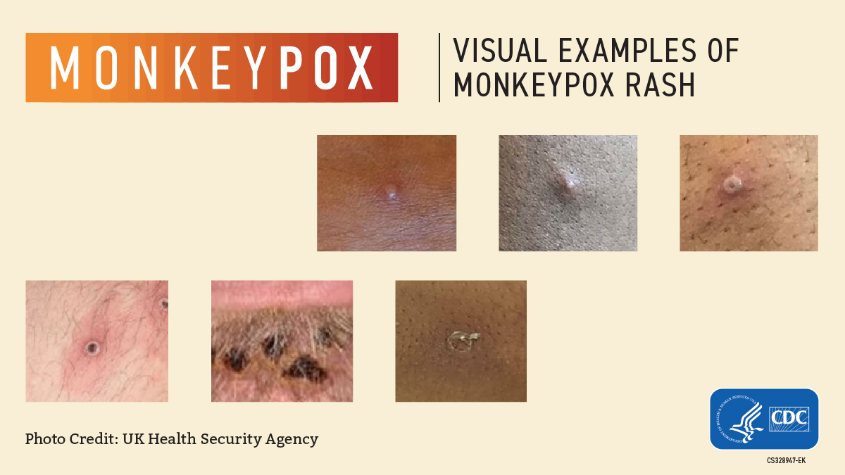 What You Should Know About Monkeypox, Touro College of Pharmacy